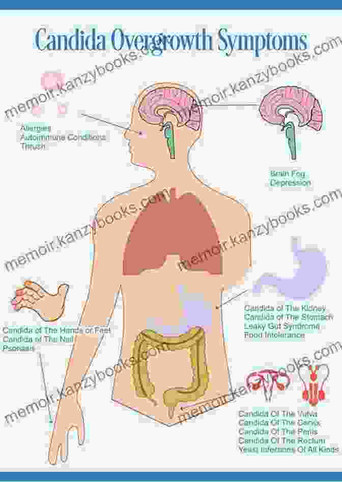 Common Symptoms Of Candida Overgrowth, Including Fatigue, Digestive Issues, And Skin Problems Coconut Oil Miracle Cures: Candida Immunity Diabetes Weight Loss Detoxification Blood Sugar Regulation Heart Health Skin And Hair Beauty Anti Aging Herpes Cancer