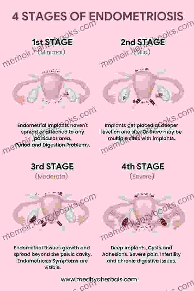 Diagram Of Endometriosis Beating Endo: How To Reclaim Your Life From Endometriosis