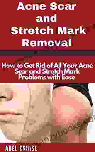 Acne Scar and Stretch Mark Removal: How to Get Rid of All Your Acne Scar and Stretch Mark Problems with Ease